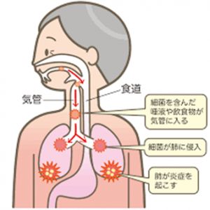 誤嚥性肺炎とは②