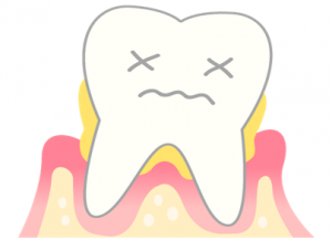 歯周病予防