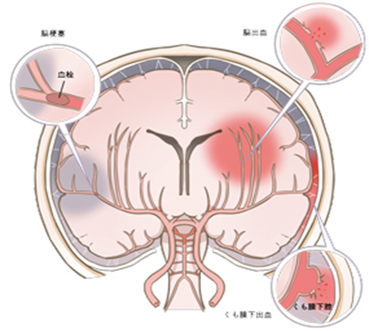 脳卒中とは